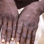Ilustrasi - Pengidap virus cacar monyet (monkeypox). (ANTARA/Sutterstock/aa)-1698302312