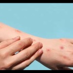 Monkeypox-1698741402